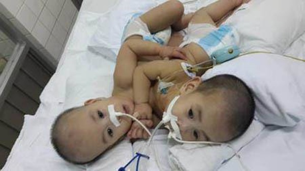 Những ca phẫu thuật tách rời song sinh đình đám của Việt Nam-3