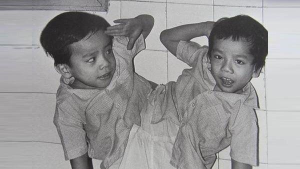 Những ca phẫu thuật tách rời song sinh đình đám của Việt Nam-5