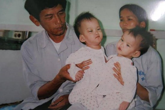 Những ca phẫu thuật tách rời song sinh 