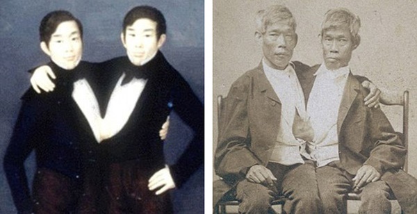 Những ca song sinh dính liền dù không phẫu thuật tách vẫn sống sót kì diệu, có cặp vẫn kết hôn và sinh tổng cộng 21 người con-2