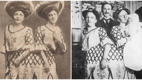 Những ca song sinh dính liền dù không phẫu thuật tách vẫn sống sót kì diệu, có cặp vẫn kết hôn và sinh tổng cộng 21 người con-6