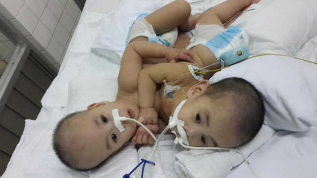 Loạt ảnh trước và sau mổ tách của các cặp song sinh dính liền nhau: Theo dõi kết quả phẫu thuật chắc chắn ai cũng phải thốt lên rằng quá kỳ diệu!-5
