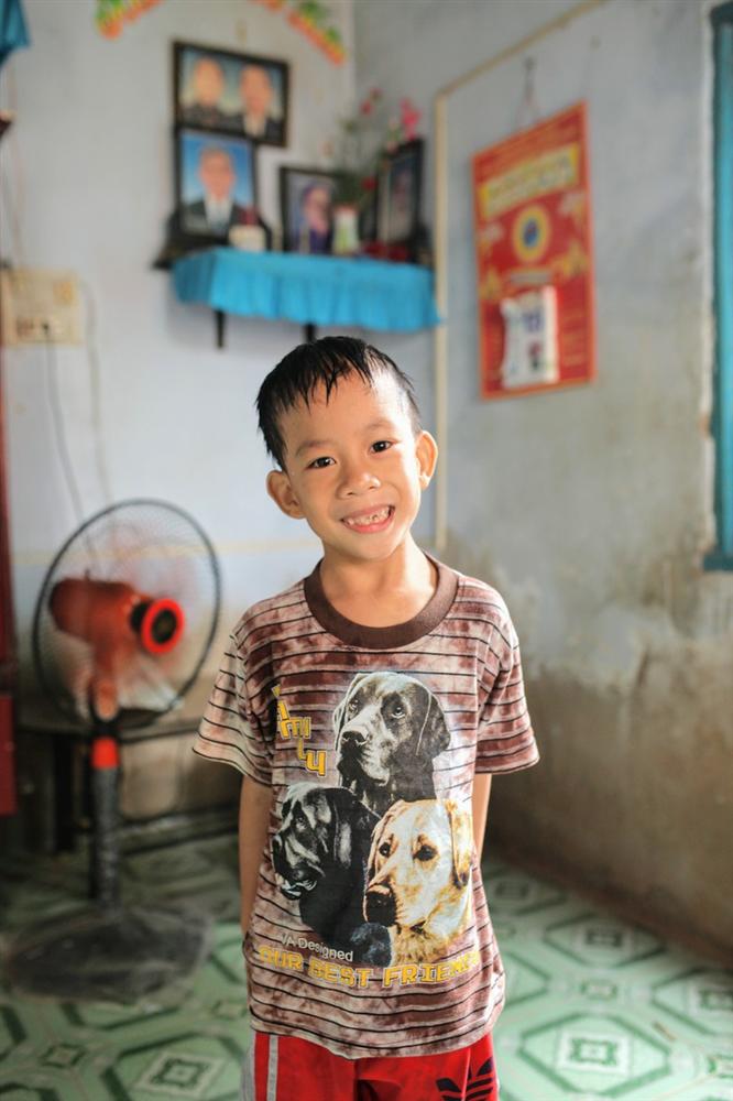 Loạt ảnh trước và sau mổ tách của các cặp song sinh dính liền nhau: Theo dõi kết quả phẫu thuật chắc chắn ai cũng phải thốt lên rằng quá kỳ diệu!-7