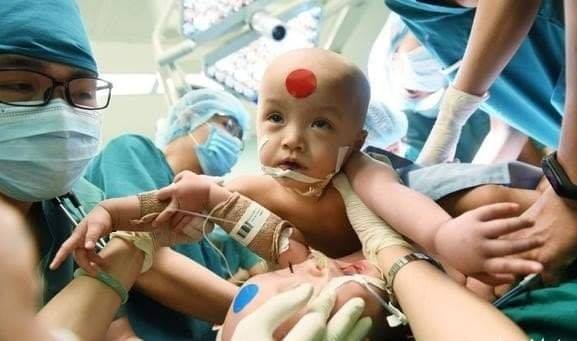 Video cận cảnh quá trình gây mê phẫu thuật tách cặp song sinh dính liền khiến người xem xúc động-1