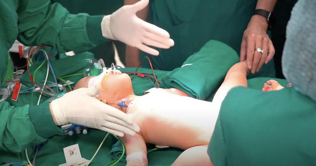 Video cận cảnh quá trình gây mê phẫu thuật tách cặp song sinh dính liền khiến người xem xúc động-2