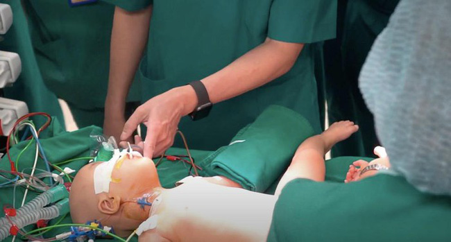 Video cận cảnh quá trình gây mê phẫu thuật tách cặp song sinh dính liền khiến người xem xúc động-5