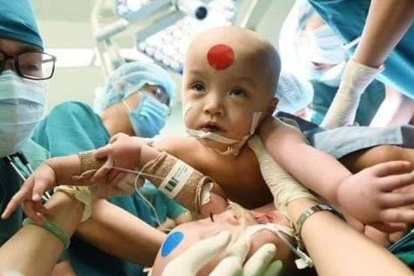 ẢNH: Khoảnh khắc xúc động trong suốt 12 tiếng phẫu thuật giúp Trúc Nhi - Diệu Nhi có được hình hài nguyên vẹn-23