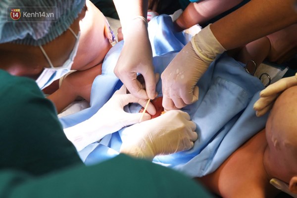 ẢNH: Khoảnh khắc xúc động trong suốt 12 tiếng phẫu thuật giúp Trúc Nhi - Diệu Nhi có được hình hài nguyên vẹn-9