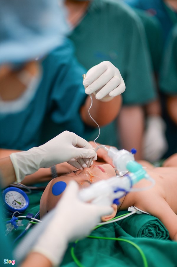 Cuộc đại phẫu đặc biệt của gần 100 bác sĩ tách song sinh dính liền-7