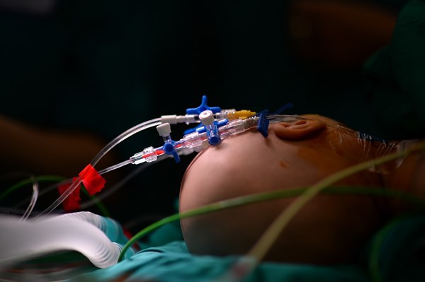 Cuộc đại phẫu đặc biệt của gần 100 bác sĩ tách song sinh dính liền-9