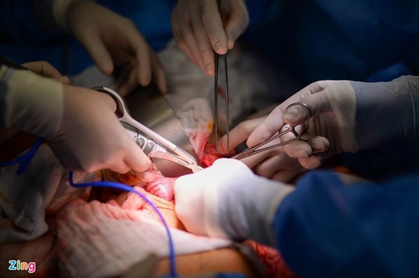 Cuộc đại phẫu đặc biệt của gần 100 bác sĩ tách song sinh dính liền-10