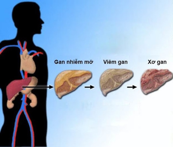 Hai căn bệnh cực kỳ phổ biến và rất dễ phát triển thành ung thư, bạn cần ngăn chặn ngay từ bây giờ-2