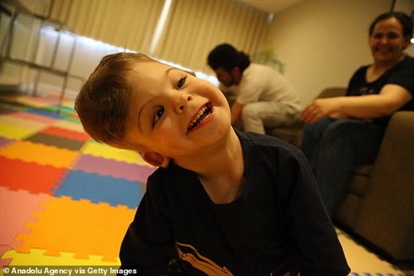 Cặp song sinh dính liền đầu, không nhìn thấy mặt nhau, tái sinh sau ca phẫu thuật tách rời-7