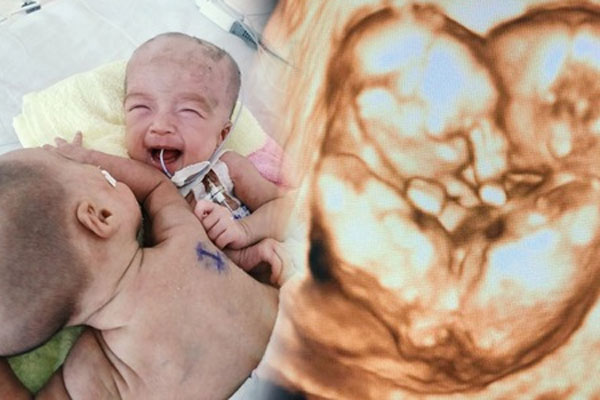 Mẹ cặp song sinh Trúc Nhi - Diệu Nhi xúc động vào thăm con sau khi tách rời: Hai con là điều đặc biệt nhất với mẹ-4