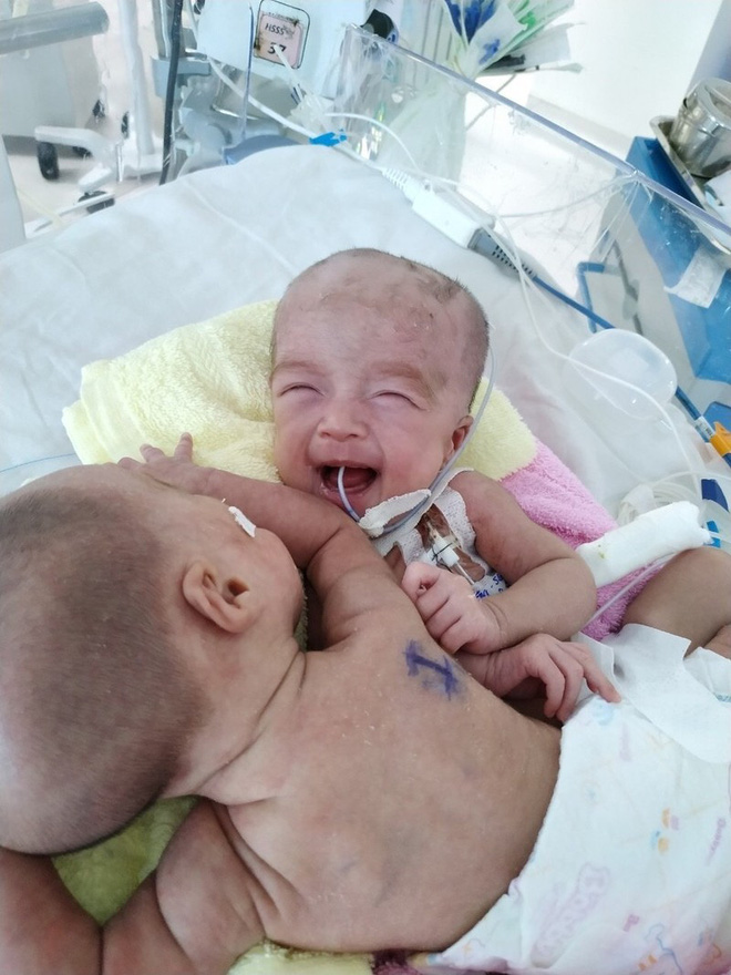 Ảnh siêu âm cặp song sinh dính liền và lời nhắn nhủ xúc động của bác sĩ 1 năm trước: Tụi con sẽ được sinh ra bởi lòng can trường của cha mẹ con-3