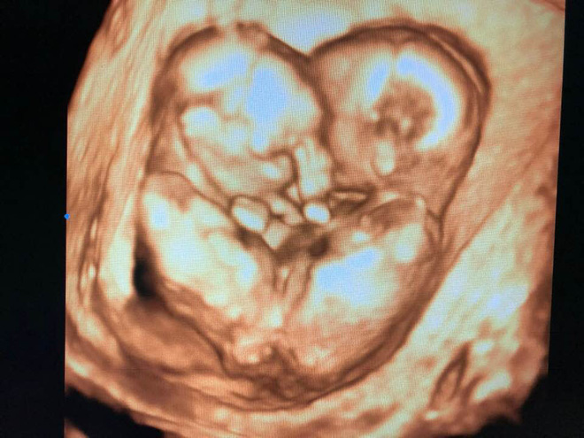 Ảnh siêu âm cặp song sinh dính liền và lời nhắn nhủ xúc động của bác sĩ 1 năm trước: Tụi con sẽ được sinh ra bởi lòng can trường của cha mẹ con-2