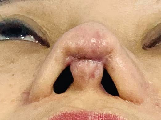 Cô gái toang hết phần mũi vì spa chữa đi chữa lại đến 4 lần-1