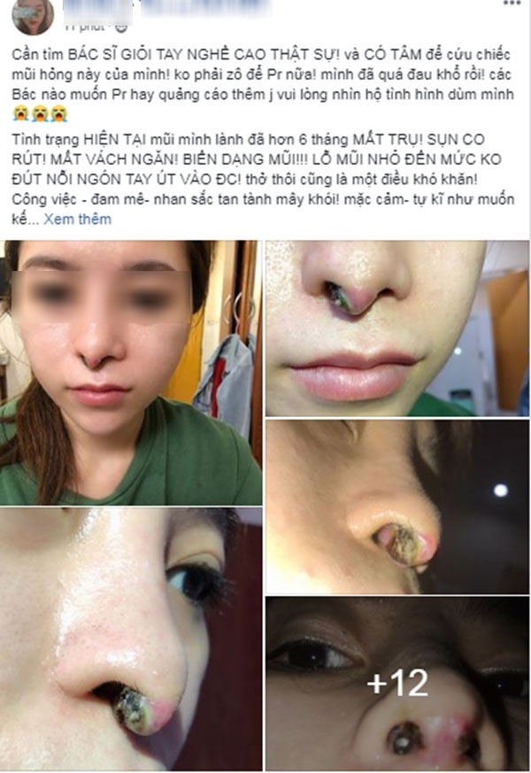 Cô gái toang hết phần mũi vì spa chữa đi chữa lại đến 4 lần-2