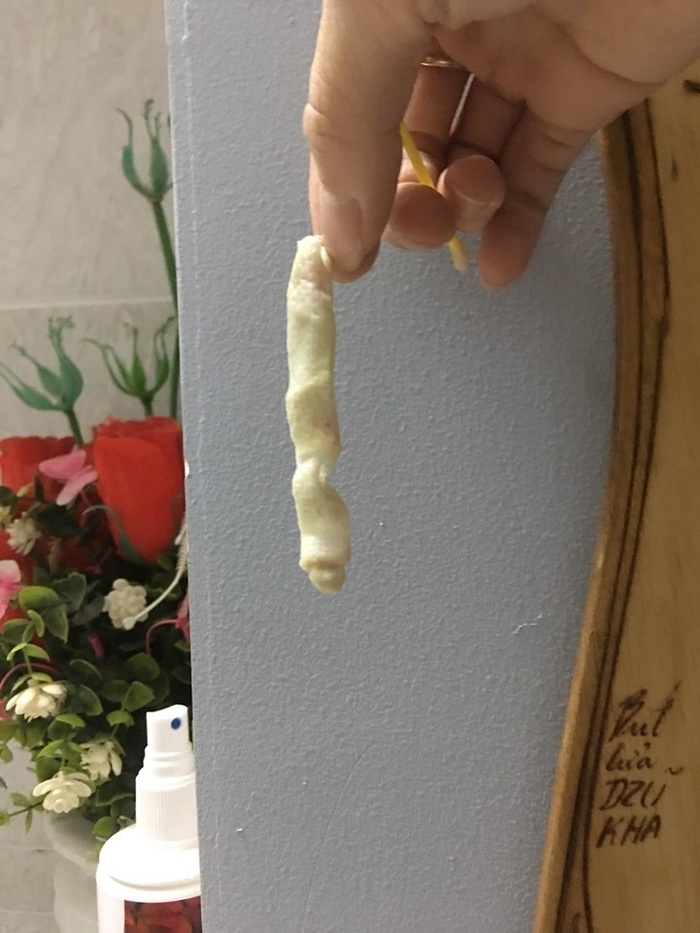 Cô gái toang hết phần mũi vì spa chữa đi chữa lại đến 4 lần-3