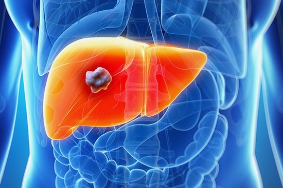 Tiết lộ bất ngờ về nguyên nhân ung thư gan, từ món ăn hàng triệu người Việt ưa thích