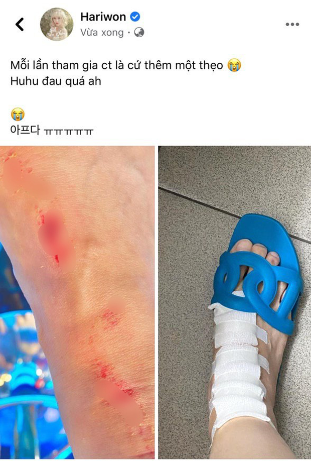 Hari Won bị chấn thương tại chương trình, Trấn Thành liền có phản ứng phũ đến mức bị vợ bóc phốt lên mạng-1