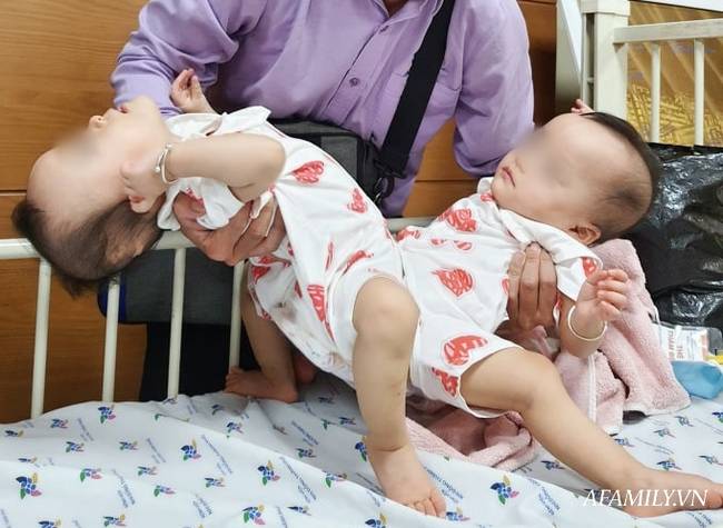 Bác sĩ ekip chỉnh hình trong ca tách song sinh Trúc Nhi - Diệu Nhi tiết lộ khoảnh khắc cuối cùng: Vừa bó bột xong là… muốn gục-1