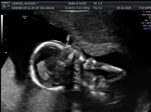 Dùng paracetamol khi đau bụng, người mẹ đau đớn nhìn hình hài con lúc chào đời-2