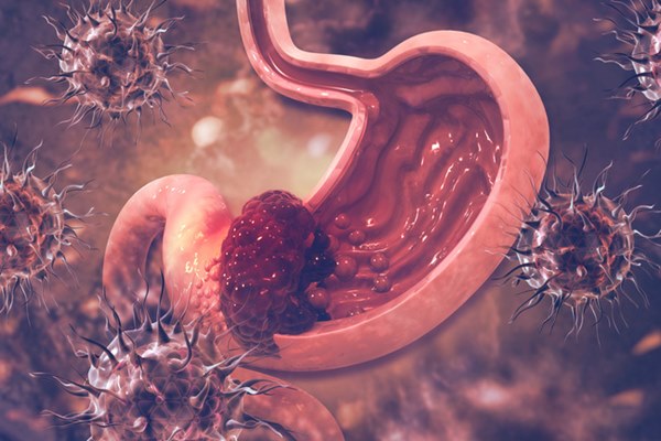 Có 4 loại ung thư cực dễ lây lan giữa vợ và chồng, nếu 1 trong 2 người mắc bệnh thì người kia cần đi khám ung thư khẩn cấp-4