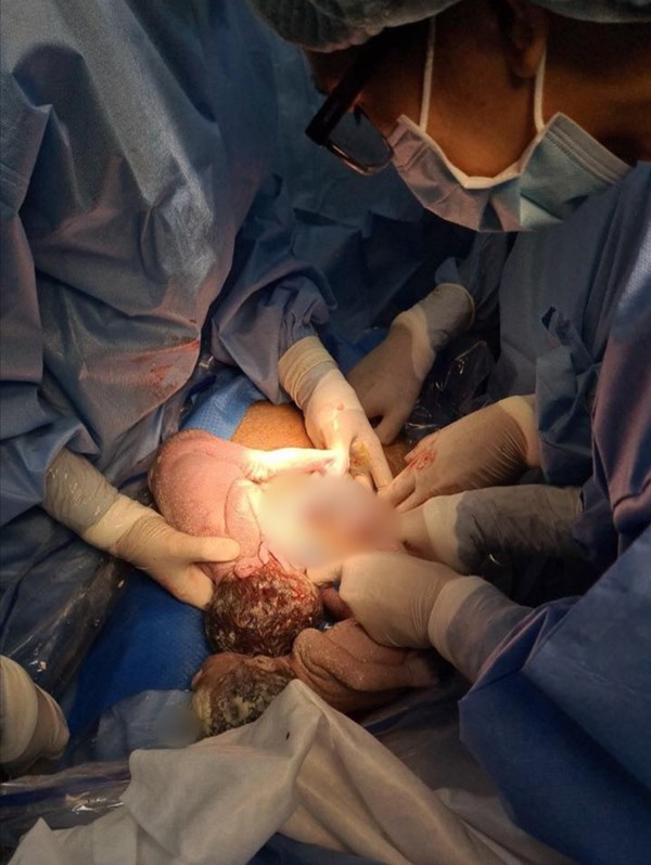 2 bé gái song sinh suýt chết trong bụng mẹ vì dây rốn vừa thắt nút vừa xoắn nhiều vòng thành 1 búi-1