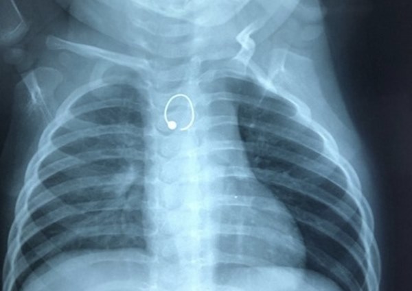 Bé gái 10 tháng tuổi suýt chết vì nuốt phải bông tai vàng sắc nhọn, ghim vào thực quản-1