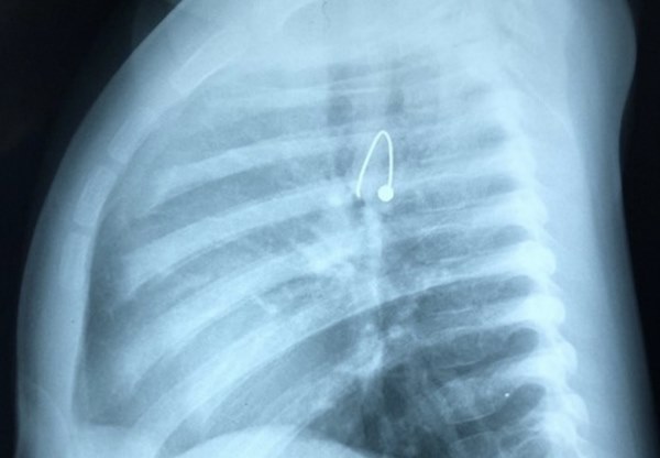 Bé gái 10 tháng tuổi suýt chết vì nuốt phải bông tai vàng sắc nhọn, ghim vào thực quản-2
