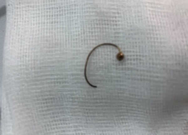 Bé gái 10 tháng tuổi suýt chết vì nuốt phải bông tai vàng sắc nhọn, ghim vào thực quản-3