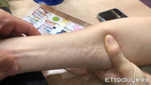 Bác sĩ ấn nhẹ đã thấy tay cô gái nổi nhiều u nang, bạn trai khiếp sợ hỏi có thể kết hôn không, bác sĩ giải đáp thế này-2