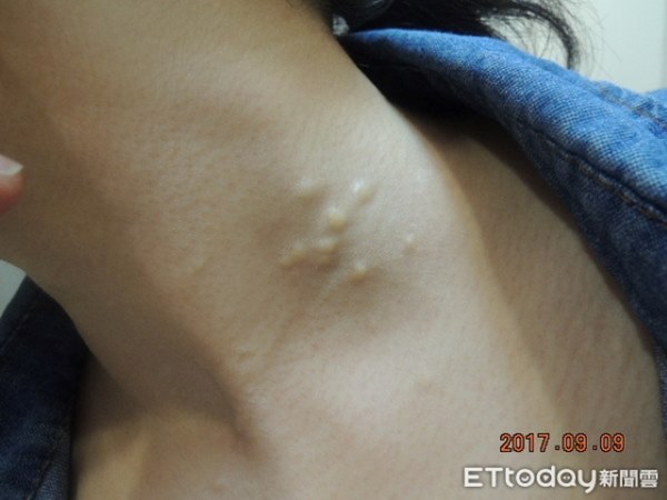 Bác sĩ ấn nhẹ đã thấy tay cô gái nổi nhiều u nang, bạn trai khiếp sợ hỏi có thể kết hôn không, bác sĩ giải đáp thế này-5