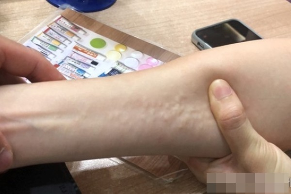 Khối u nặng 3 kg trong buồng trứng nữ bệnh nhân-2