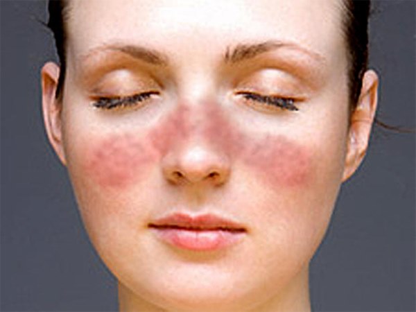Các bất thường nhỏ trên gương mặt hé lộ các bệnh nguy hiểm-3