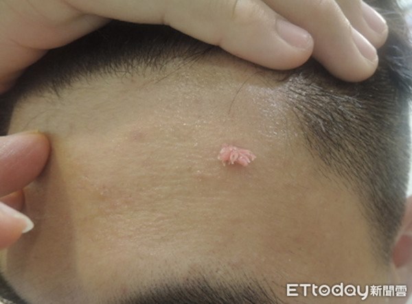 Xuất hiện u nhú màu hồng tươi trên trán, chàng trai nhổ mãi vẫn mọc lại, đi khám mới biết đó là dấu hiệu của bệnh thường gặp ở vùng kín-1