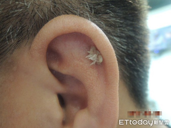 Xuất hiện u nhú màu hồng tươi trên trán, chàng trai nhổ mãi vẫn mọc lại, đi khám mới biết đó là dấu hiệu của bệnh thường gặp ở vùng kín-5