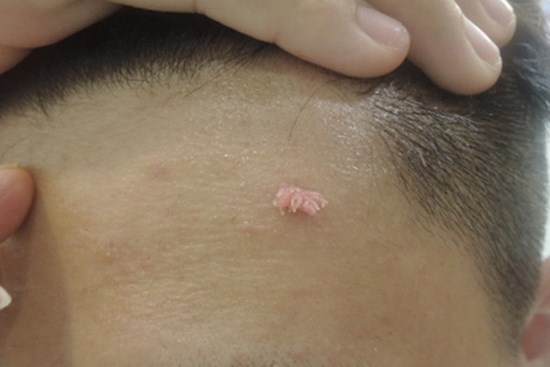 Xuất hiện u nhú màu hồng tươi trên trán, chàng trai nhổ mãi vẫn mọc lại, đi khám mới biết đó là dấu hiệu của bệnh thường gặp ở vùng kín