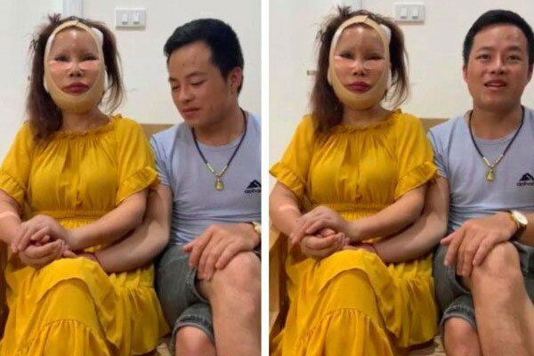 1 tháng sau dao kéo, cô dâu 63 tuổi ở Cao Bằng mặt sưng phù, sẹo chằng chịt-1