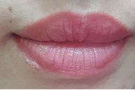 Xăm môi được 3 ngày thì bị mụn rộp herpes ở môi, 2 tuần sau tổn thương toàn thân: 3 nguy cơ có thể gặp sau khi phun xăm bác sĩ muốn mọi người cần biết