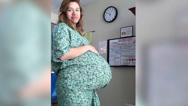 Ca sinh ba độc nhất thế giới, 2 bé dính liền giống Trúc Nhi - Diệu Nhi sau 4 năm-2