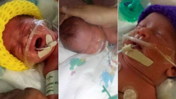 Ca sinh ba độc nhất thế giới, 2 bé dính liền giống Trúc Nhi - Diệu Nhi sau 4 năm-3