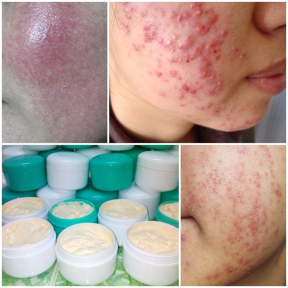 Trước khi đầu tư một lọ kem trị nám/ tàn nhang, nàng 30+ cần tìm hiểu thật kỹ 2 điều này, cẩn thận không nát mặt như chơi-4