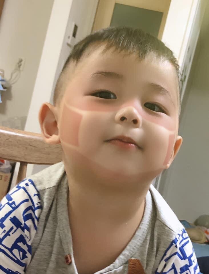 Xôn xao khắp Facebook: Xuất hiện nhiều em bé bị cháy nắng bá đạo, in hằn nguyên chiếc khẩu trang trên mặt, chuyện gì đang xảy ra?-8