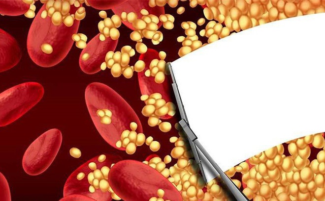 Cách đơn giản để xác định có bị mỡ máu hay không: Đừng bỏ qua mà nguy hiểm tính mạng-1