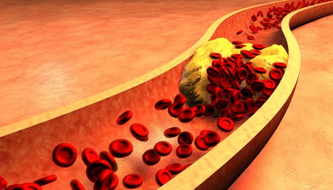 Cách đơn giản để xác định có bị mỡ máu hay không: Đừng bỏ qua mà nguy hiểm tính mạng-2