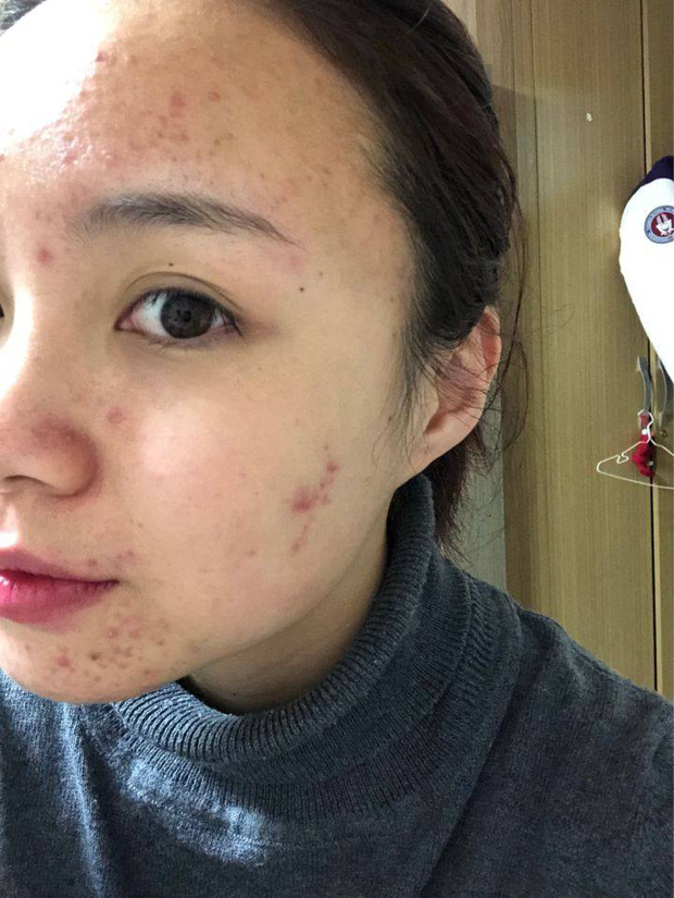 Dũng cảm công khai mặt mộc đầy mụn, cô gái chua chát: Ngũ quan đẹp mà da xấu thì cũng... vứt đi!-1