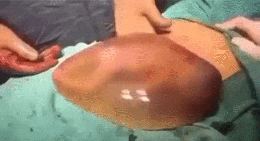 Đoạn clip khiến người xem không thể rời mắt: Em bé vừa sinh ra đã quậy tưng bừng, nhảy múa lộn nhào trong bọc ối-1