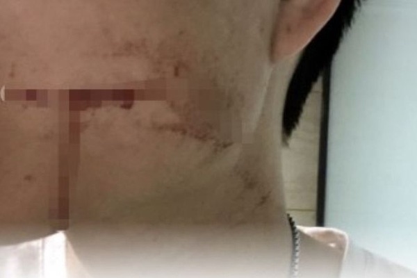 Cô gái 23 tuổi tử vong sau nhổ răng khôn: Bác sĩ chỉ ra những lưu ý tránh biến chứng nguy hiểm-5